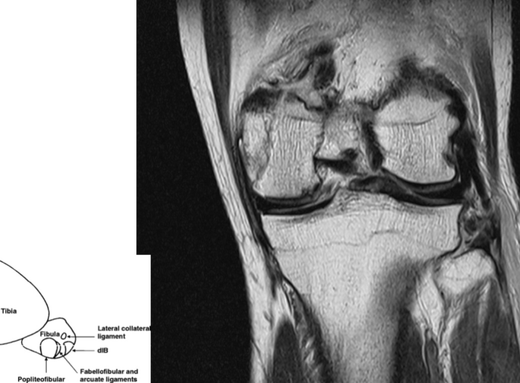 Figure 4 for case arcuate sign